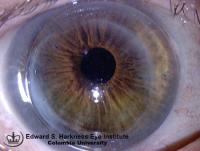 Astigmatism post penetrating keratoplasty is satisfactorily corrected with contact lens.